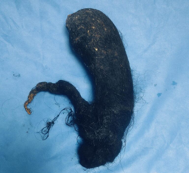 Hair Raising Recovery For Teen Girl: 1.5 KG Hairball Removed from Stomach